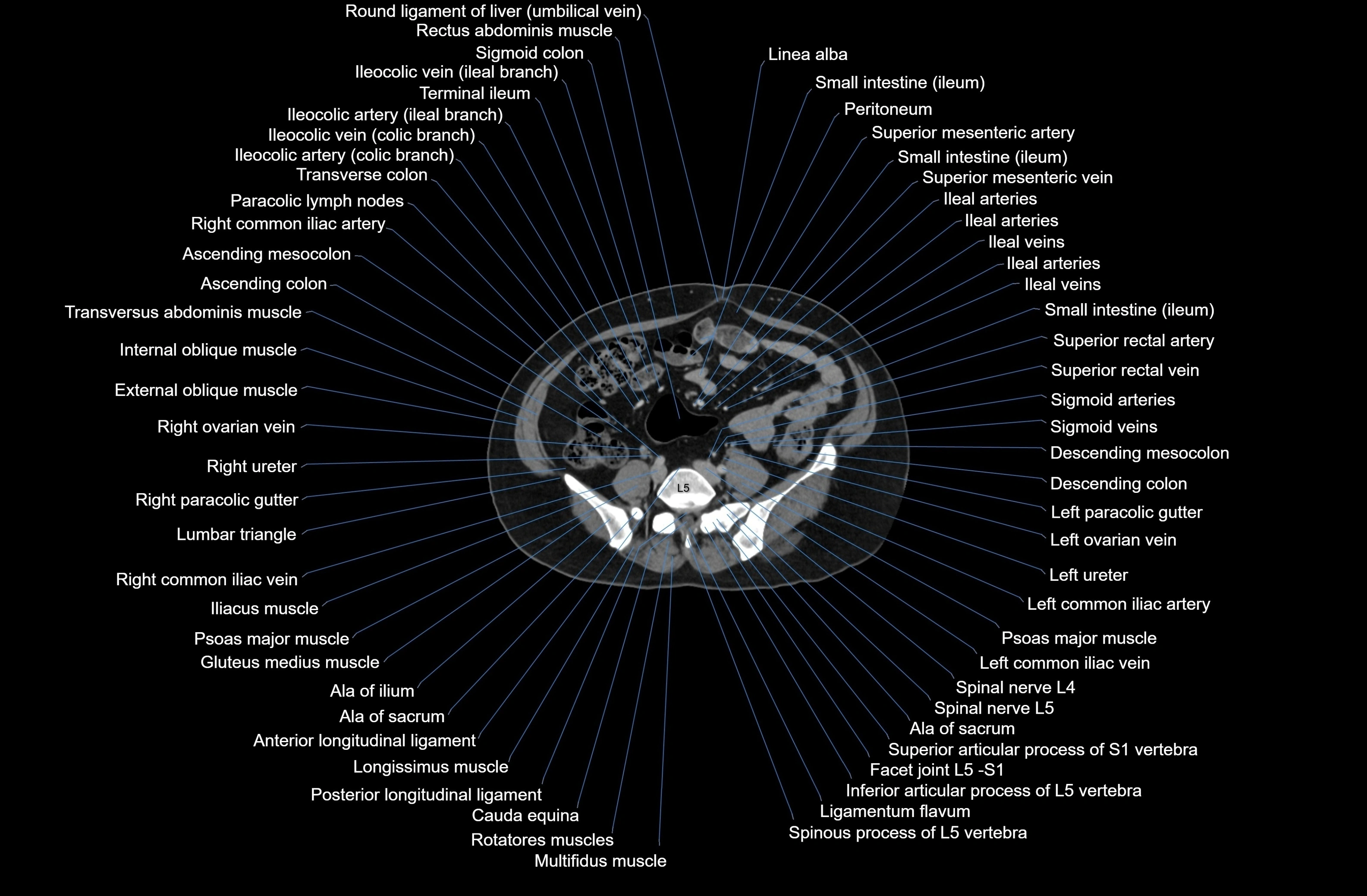 CT Abdomen axial cross sectional anatomy labelled radiology image-00061.webp